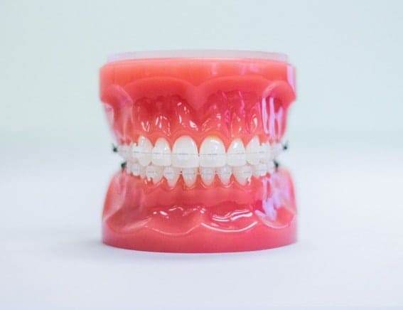 Clear Braces at SmileOn Orthodontics